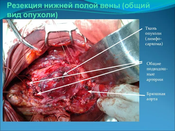 Резекция нижней полой вены (общий вид опухоли) Ткань опухоли (лимфо-саркома) Общие подвздош-ные артерии Брюшная аорта