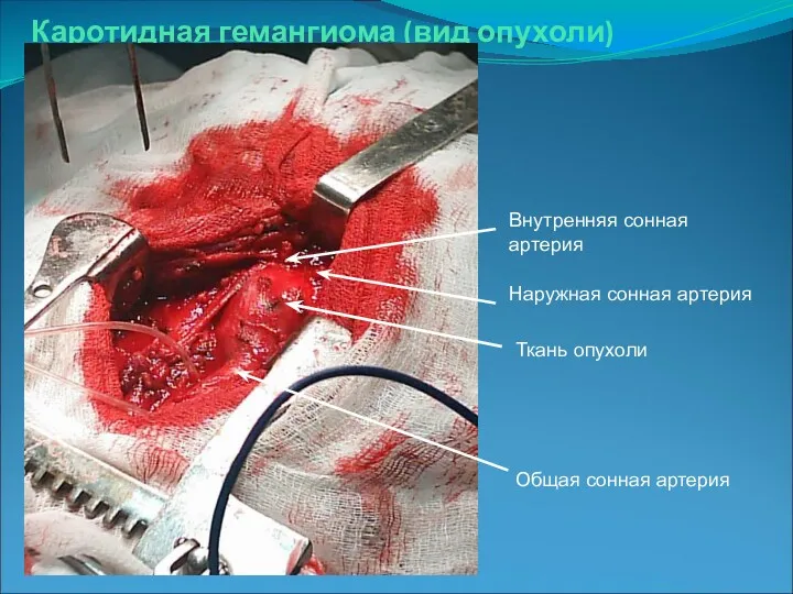 Каротидная гемангиома (вид опухоли) Ткань опухоли Общая сонная артерия Наружная сонная артерия Внутренняя сонная артерия