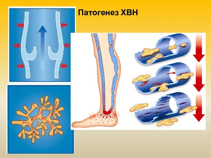 Патогенез ХВН