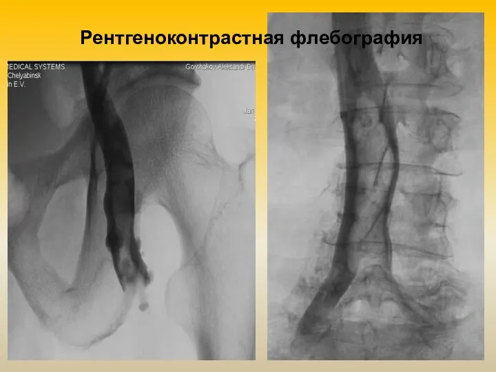 Рентгеноконтрастная флебография