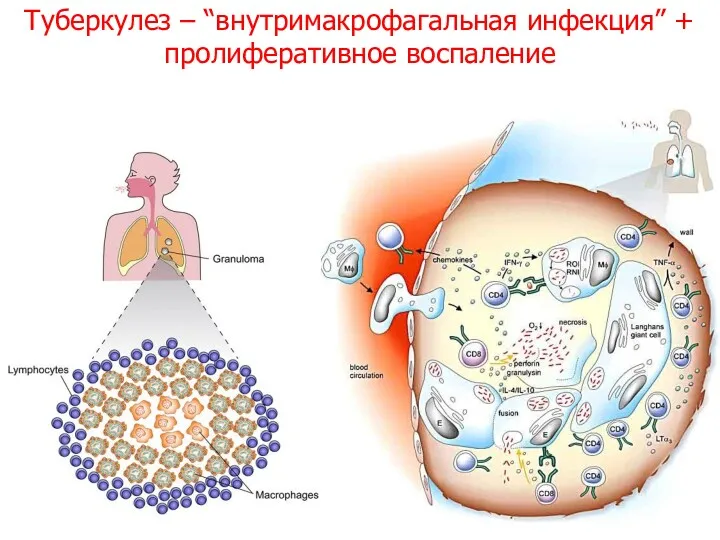 Туберкулез – “внутримакрофагальная инфекция” + пролиферативное воспаление