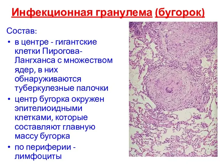 Инфекционная гранулема (бугорок) Состав: в центре - гигантские клетки Пирогова-Лангханса