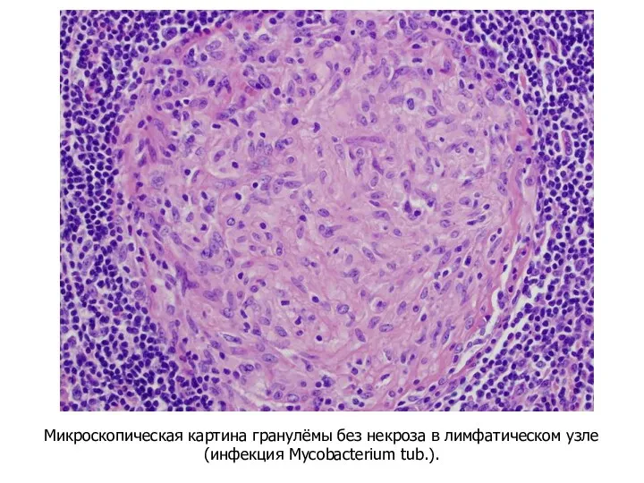 Микроскопическая картина гранулёмы без некроза в лимфатическом узле (инфекция Mycobacterium tub.).