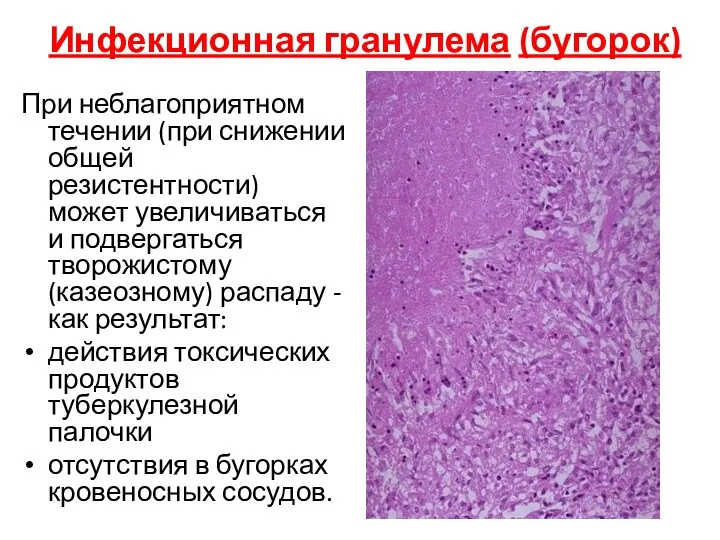 Инфекционная гранулема (бугорок) При неблагоприятном течении (при снижении общей резистентности)