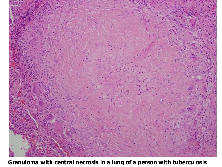 Granuloma with central necrosis in a lung of a person with tuberculosis