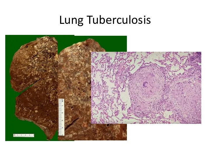 Lung Tuberculosis
