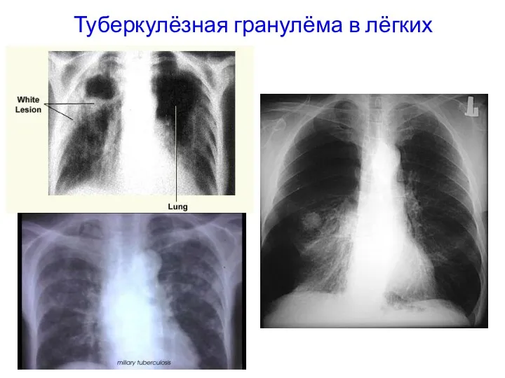 Туберкулёзная гранулёма в лёгких