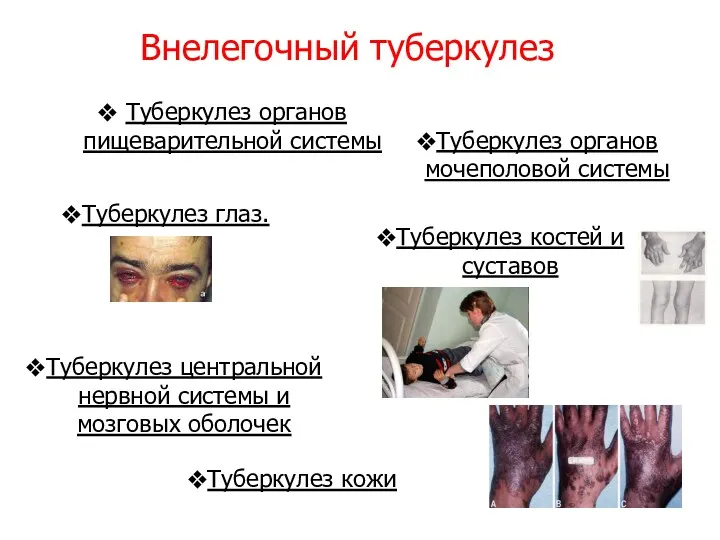 Туберкулез глаз. Внелегочный туберкулез Туберкулез органов пищеварительной системы Туберкулез органов