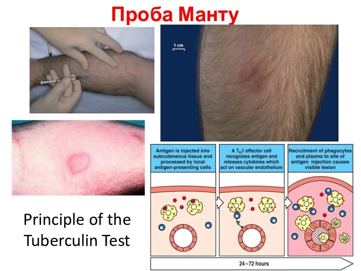 Проба Манту Principle of the Tuberculin Test