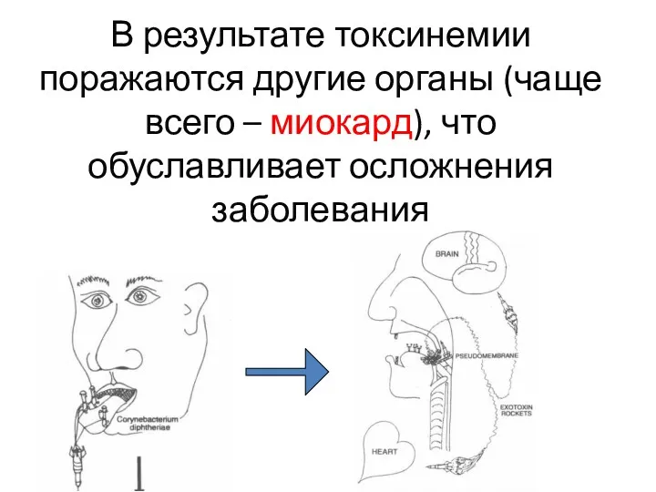 В результате токсинемии поражаются другие органы (чаще всего – миокард), что обуславливает осложнения заболевания