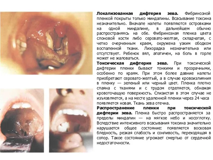 Локализованная дифтерия зева. Фибринозной пленкой покрыты только миндалины. Всасывание токсина