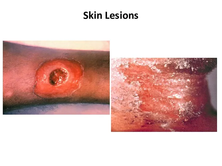 Skin Lesions