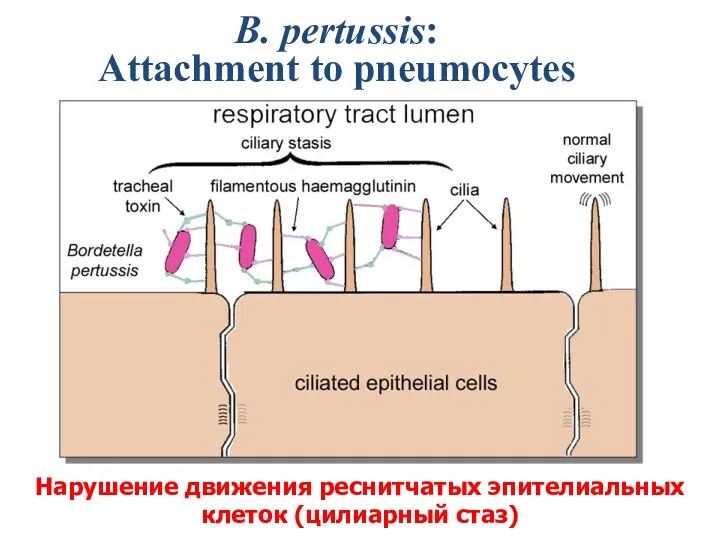 B. pertussis: Attachment to pneumocytes Нарушение движения реснитчатых эпителиальных клеток (цилиарный стаз)