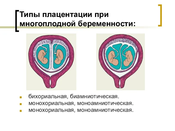 Типы плацентации при многоплодной беременности: бихориальная, биамниотическая. монохориальная, моноамниотическая. монохориальная, моноамниотическая.