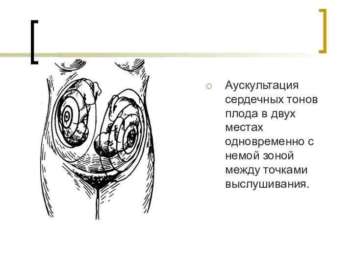 Аускультация сердечных тонов плода в двух местах одновременно с немой зоной между точками выслушивания.