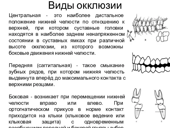 Виды окклюзии Центральная - это наиболее дистальное положение нижней челюсти