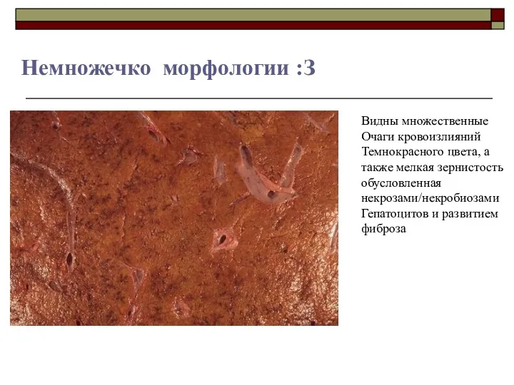 Немножечко морфологии :З Видны множественные Очаги кровоизлияний Темнокрасного цвета, а