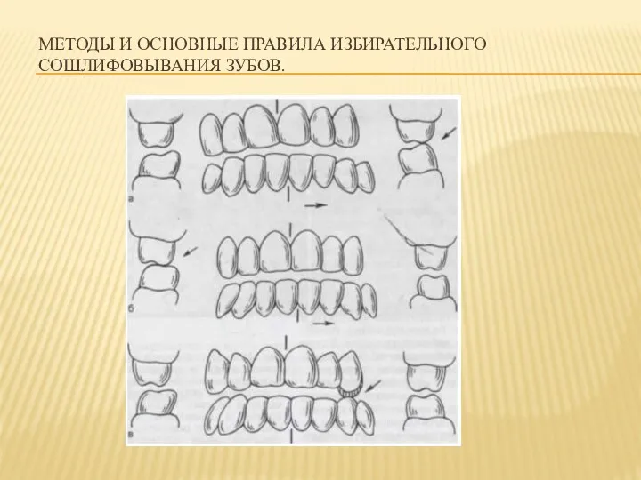 МЕТОДЫ И ОСНОВНЫЕ ПРАВИЛА ИЗБИРАТЕЛЬНОГО СОШЛИФОВЫВАНИЯ ЗУБОВ.