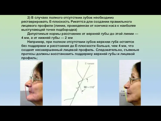 2) В случаях полного отсутствия зубов необходимо реставрировать Е-плоскость Рикеттса