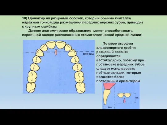 10) Ориентир на резцовый сосочек, который обычно считался надежной точкой