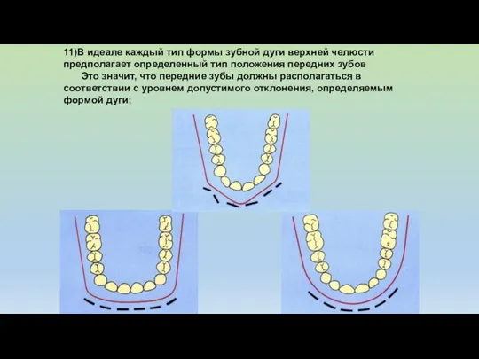 11)В идеале каждый тип формы зубной дуги верхней челюсти предполагает