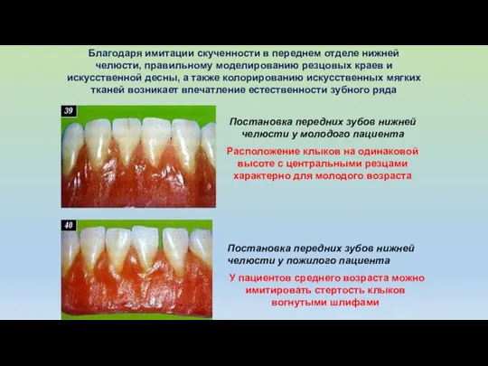 Благодаря имитации скученности в переднем отделе нижней челюсти, правильному моделированию