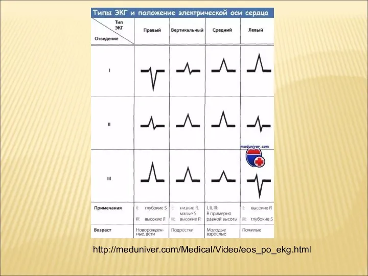 http://meduniver.com/Medical/Video/eos_po_ekg.html