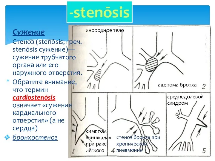 Сужение Стеноз (stenōsis; греч. stenōsis сужение)— сужение трубчатого органа или