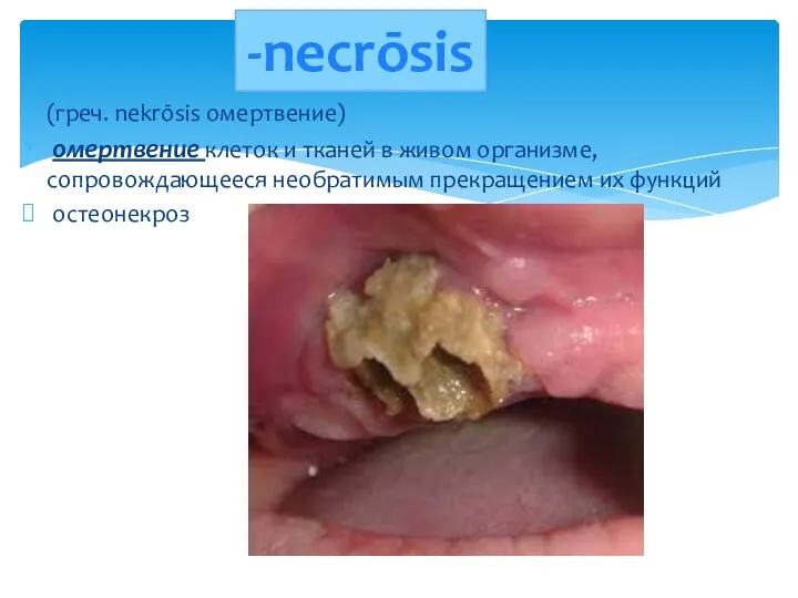 (греч. nekrōsis омертвение) омертвение клеток и тканей в живом организме,