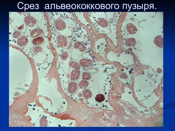 Срез альвеококкового пузыря.