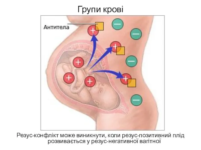 Групи крові Резус-конфлікт може виникнути, коли резус-позитивний плід розвивається у резус-негативної вагітної