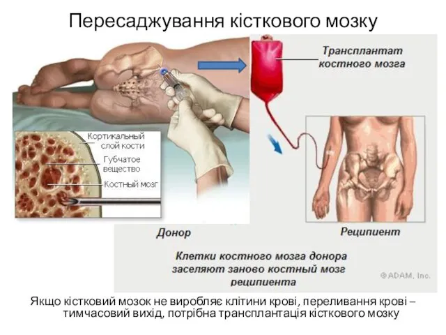 Пересаджування кісткового мозку Якщо кістковий мозок не виробляє клітини крові,
