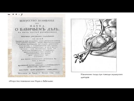 Извлечение плода при помощи акушерских щипцов «Искусство повивания или Наука о бабичьем»