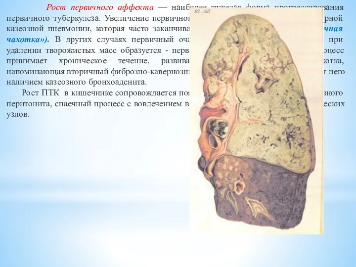 Рост первичного аффекта — наиболее тяжелая форма прогрессирования первичного туберкулеза.