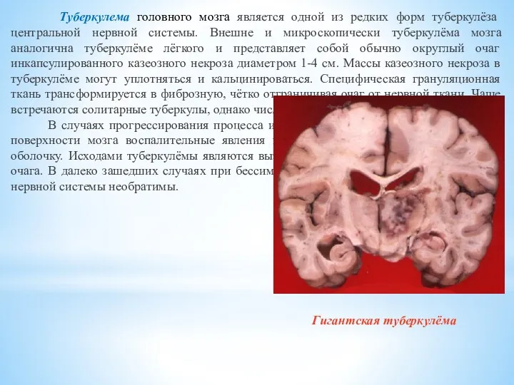 Туберкулема головного мозга является одной из редких форм туберкулёза центральной