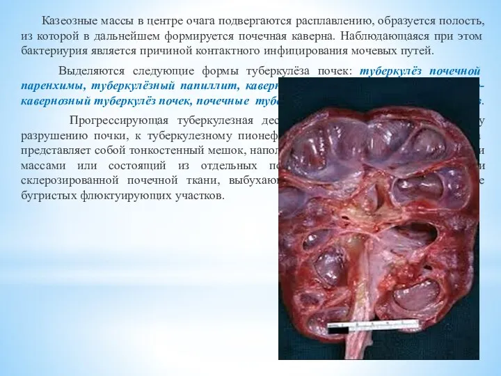 Казеозные массы в центре очага подвергаются расплавлению, образуется полость, из