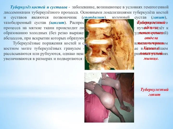 Туберкулёз костей и суставов - заболевание, возникающее в условиях гематогенной