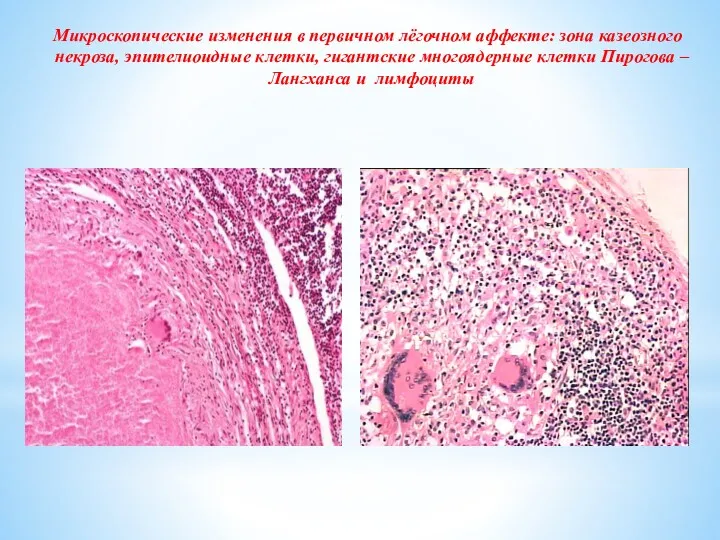 Микроскопические изменения в первичном лёгочном аффекте: зона казеозного некроза, эпителиоидные