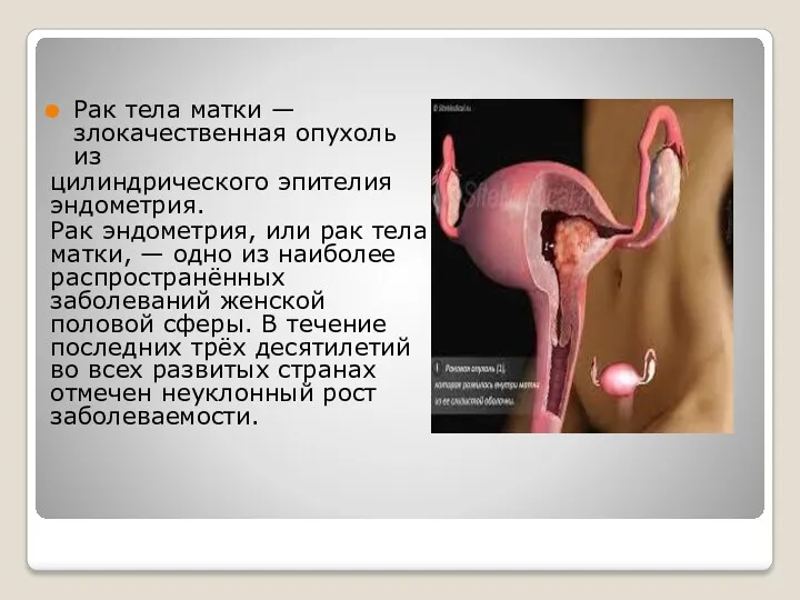 Рак тела матки — злокачественная опухоль из цилиндрического эпителия эндометрия.