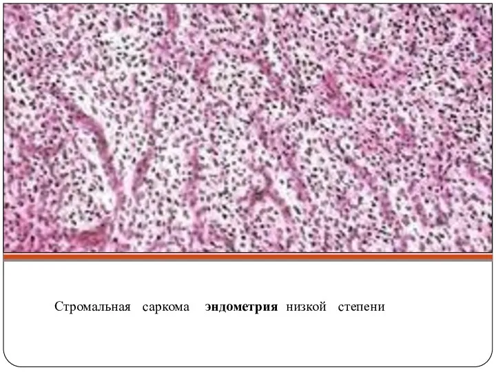 Стромальная саркома эндометрия низкой степени