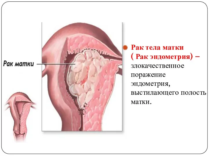 Рак тела матки ( Рак эндометрия) – злокачественное поражение эндометрия, выстилающего полость матки.