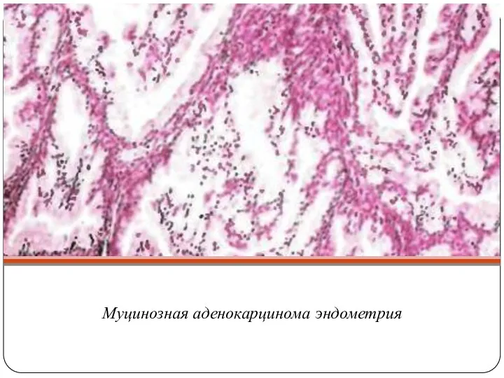 Муцинозная аденокарцинома эндометрия
