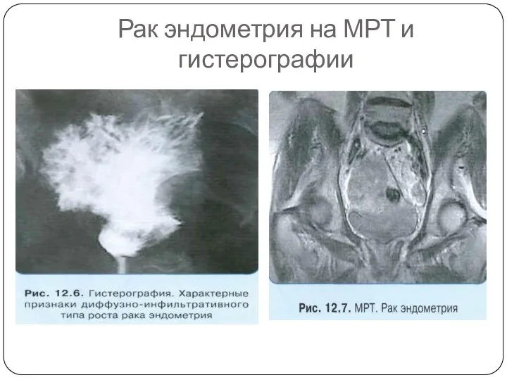 Рак эндометрия на МРТ и гистерографии