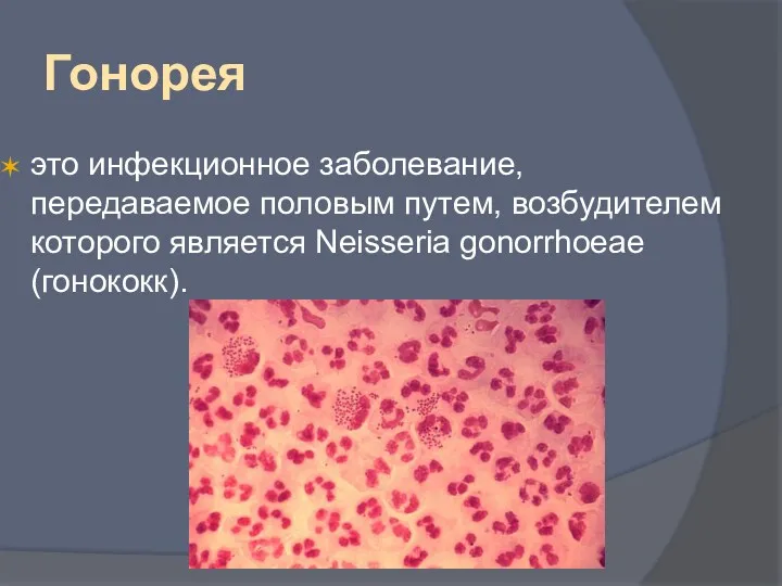 Гонорея это инфекционное заболевание, передаваемое половым путем, возбудителем которого является Neisseria gonorrhoeae (гонококк).