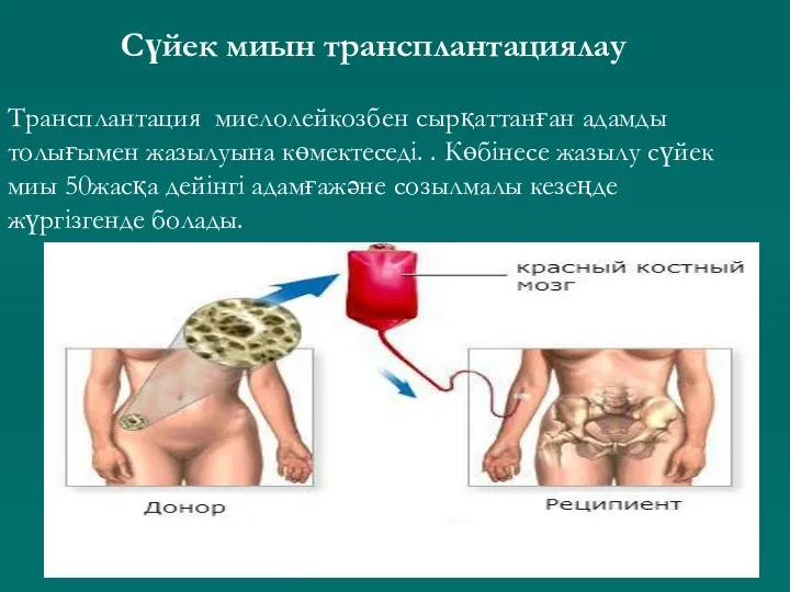 Сүйек миын трансплантациялау Трансплантация миелолейкозбен сырқаттанған адамды толығымен жазылуына көмектеседі.