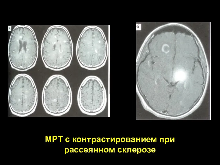 МРТ с контрастированием при рассеянном склерозе