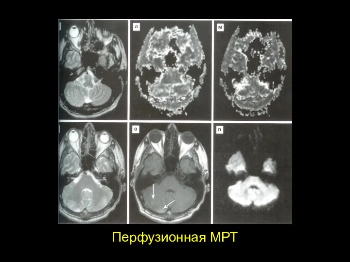 Перфузионная МРТ