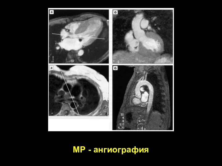 МР - ангиография