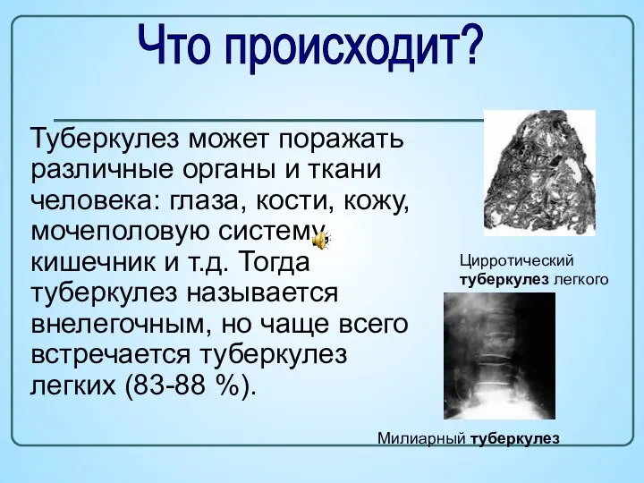 Туберкулез может поражать различные органы и ткани человека: глаза, кости,