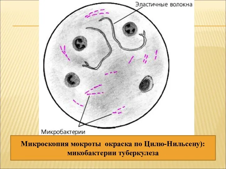 Микроскопия мокроты окраска по Цилю-Нильсену): микобактерии туберкулеза